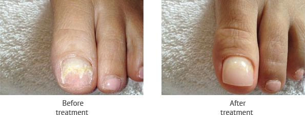 Cosmetic Nail Repair | Foot Doctor Long Beach, CA 90808