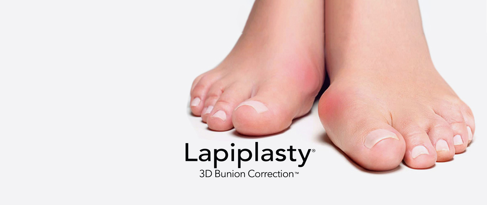slide-lapiplasty