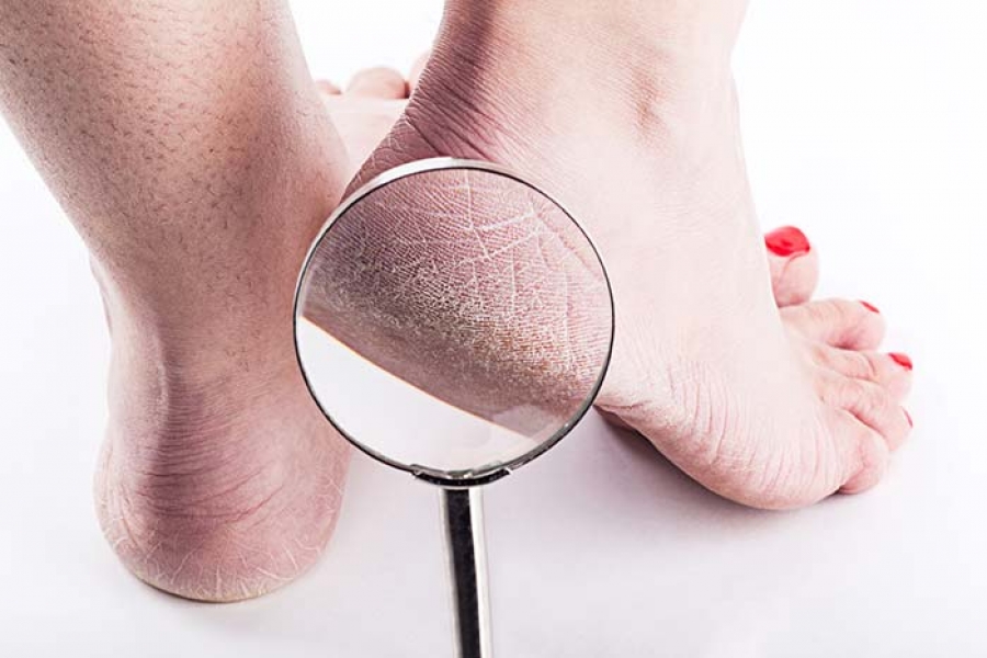 Dry Cracked Heels - Causes, Prevention, Home Remedies and Treatment