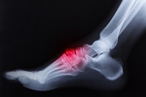 Stress Fractures and Vitamin D