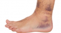 The Possible Causes of Feet Discoloration