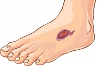 Foot Ulcers and Diabetes