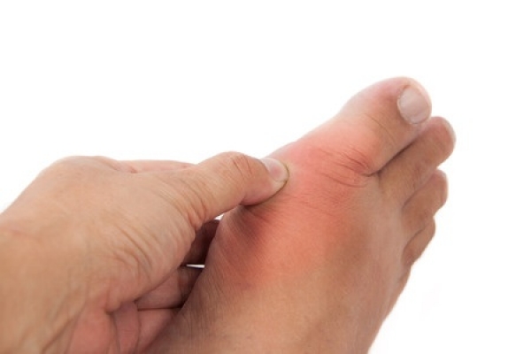 What Launches Gout Attacks?
