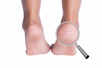 How Do Heel Fissures Differ From Cracked Heels?