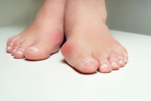 What’s Behind Bunions?