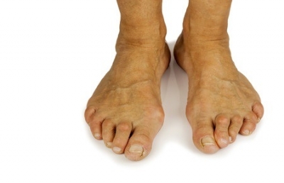 Questions about Bunion Surgery