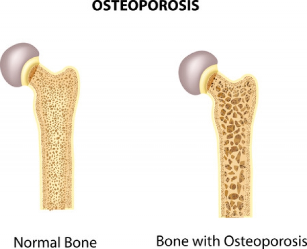 Stress Fractures May Signal Osteoporosis