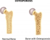 Stress Fractures May Signal Osteoporosis