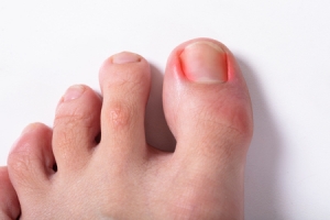 What to Do (and Not Do) for Ingrown Toenails