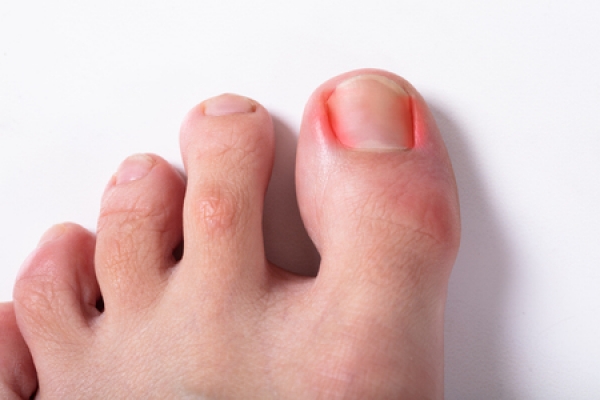 What to Do (and Not Do) for Ingrown Toenails