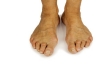 Dealing with Bunions
