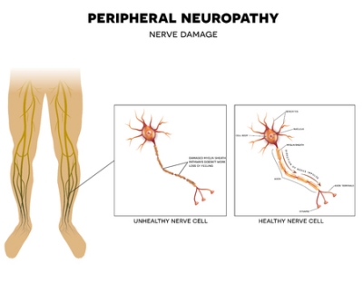 Facts about Alcoholic Neuropathy