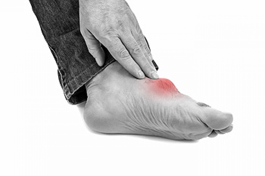 Gout Heel Pain Gout In The Sore Heel On Foot Gout In The Highest