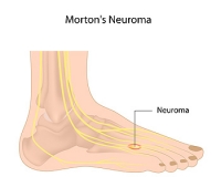 Stretches That May Relieve Pain from Morton Neuroma