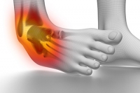 Who Is Prone to Getting Ankle Sprains?